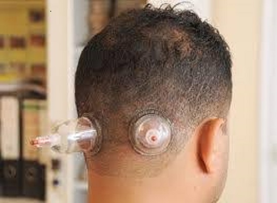  حجامة لعلاج الصداع المزمن والتوتر العصبي